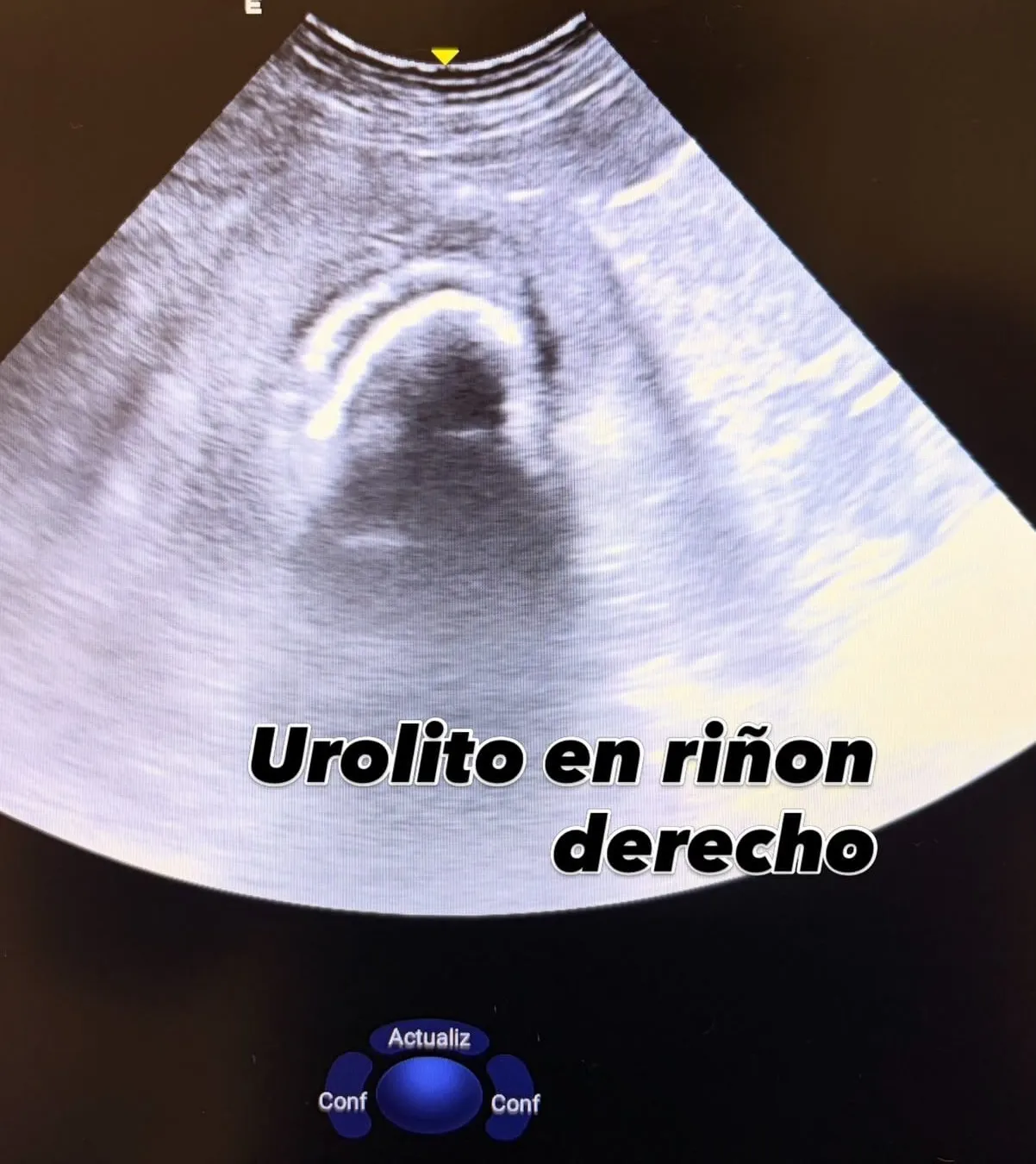 Imagen ecográfica: urolito en riñón derecho