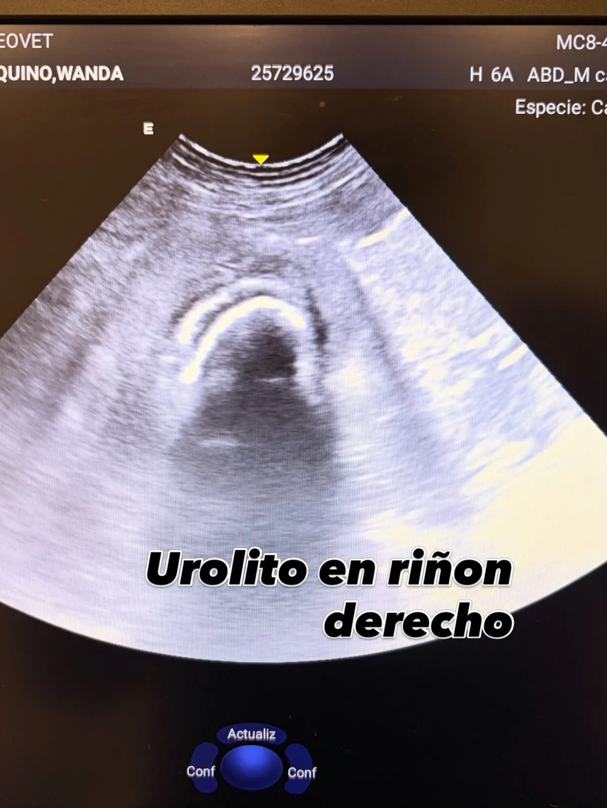 Imagen ecográfica: urolito en riñón derecho