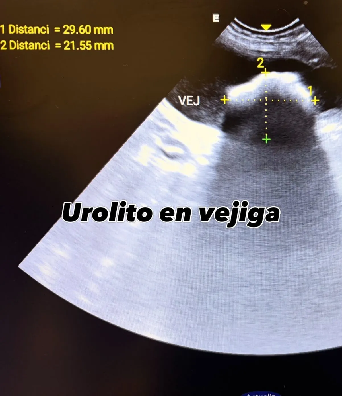 Imagen ecográfica: urolito en vejiga, con mediciones